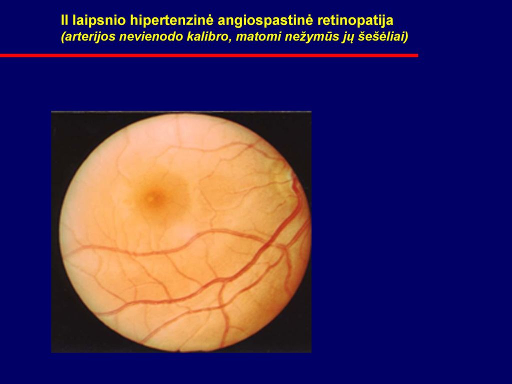 retinopatija hipertenzija